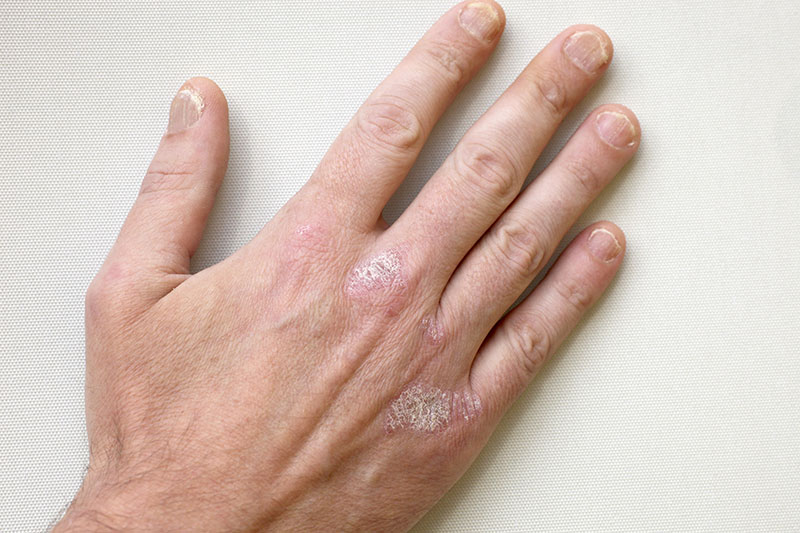 Psoriasis-Symptome an der Handoberfläche